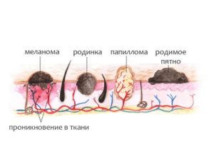 melanoma-1