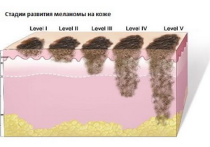 melanoma