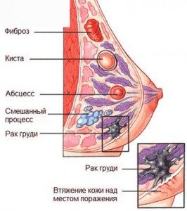fibroadenoma-4