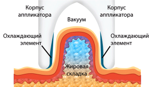 криолиполиз