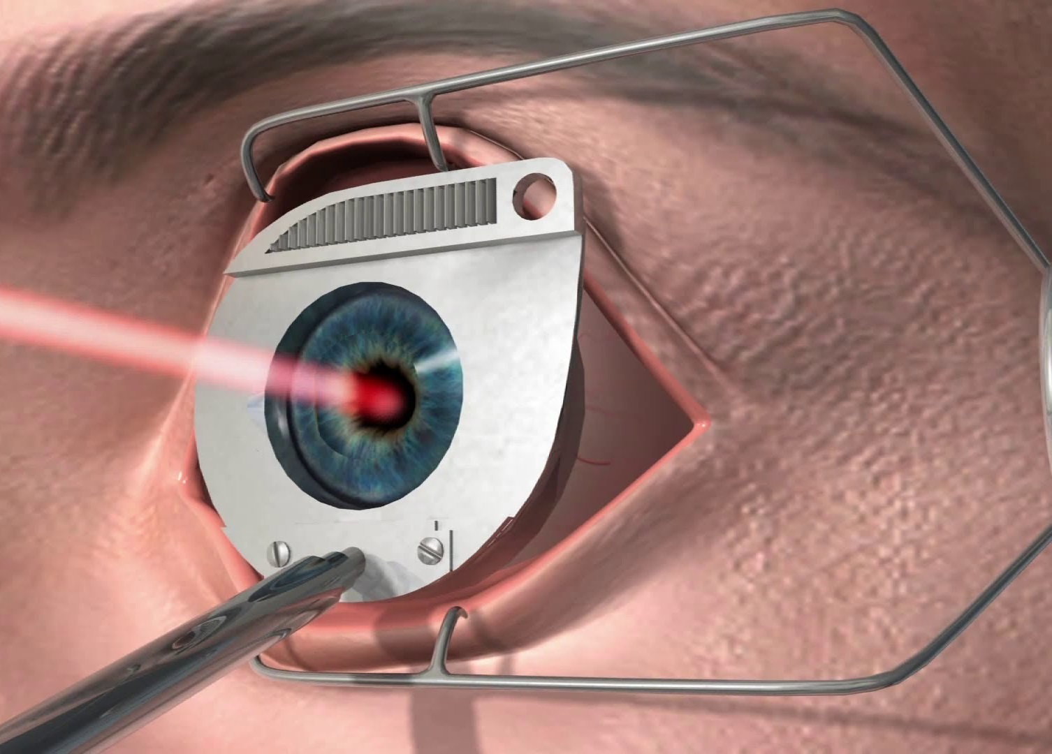 Коррекция зрения методом смайл. Фемто ласик. ФРК ласик. Лазерная операция на глаза.